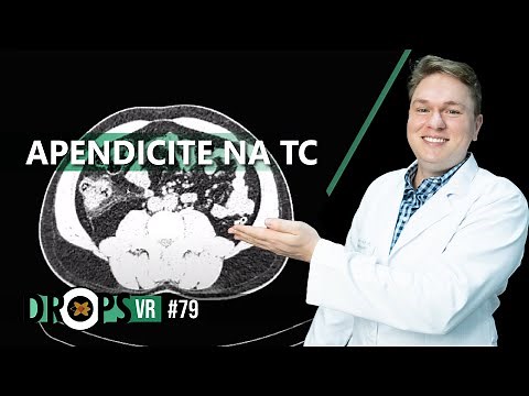 APENDICITE NA TC PASSO A PASSO
