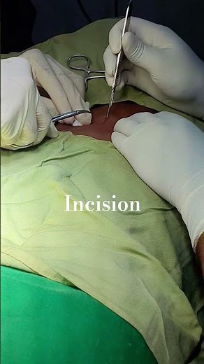 Sebaceous cyst. check out description for more info