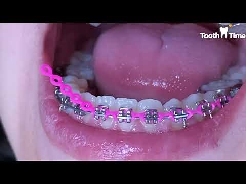 Braces checkups - Power chains - 16 months with braces - Tooth Time Family Dentistry