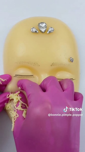 Close-up of the last pimples disappearing, her face is beautiful again. satisfying?? #capcut #asmr #asmrtiktoks #viralvideo #fyp #pimples #pimple_popper_asmr #tingles #asmrtingles #asmrtriggers #asmrsounds #mouthsounds #acnetreatments #mochipimplepopping #bonniepimplepopperasmr