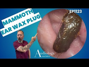 Huge Ear Wax Plug Removal! Chunky Skin Peels & Shocking Extractions 😱👂 - EP1123