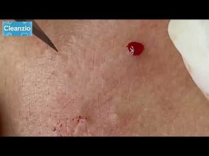#055 Close-Up Pore Strip Removal | Satisfying Blackhead Pulling You Can’t Miss