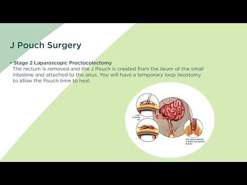 J Pouch Surgery