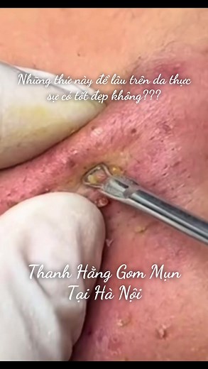Thanh Hằng gom mụn tại Hà Nội – Spa trị mụn hiệu quả