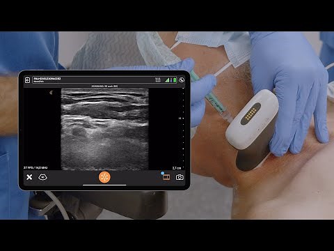 USG Interscalene Block