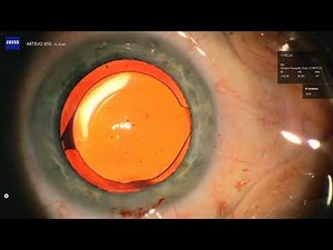First Look: Clareon PanOptix Pro Trifocal IOL + AutonoMe Preload System - Omar Shakir at Coastal Eye
