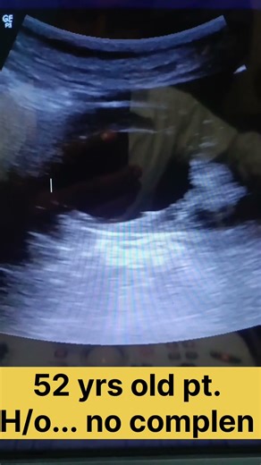 A large renal cyst with no any complen #education #cyst