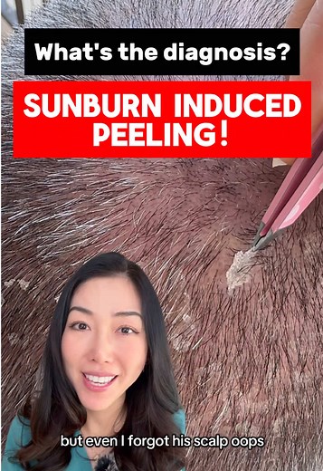 It’s scalp peeling from a sunburn! 🥵☀️ Psoriasis was a good guess for those who have your differential diagnosis but this scale is quite thin compared to thicker “silvery” scale of psoriasis. This was my dad’s scalp which got pretty sunburnt after just a few hours in swimming pool for a few days while we were on vacation 🌴. This is one of the reasons I always have a hat on my kids and myself whenever possible. Even though our hair 👩‍🦰👨‍🦰offers some protection against UV, there are still ar