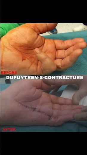 Dupuytren's Contracture Surgery | Treatment Options & Recovery