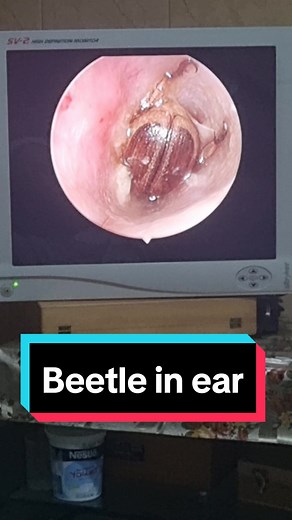 Removal of beetle from ear #fyp #foryoupage #foryou #doctor #ent #insect
