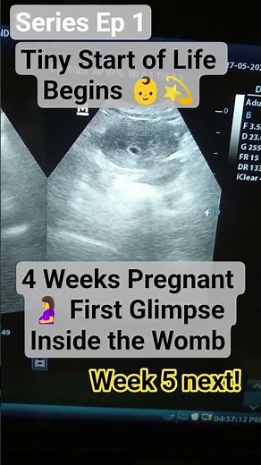 Early Pregnancy Scan – 4 Weeks (Ep 1) | 5 Week Next! #ultrasound #shortsvideo