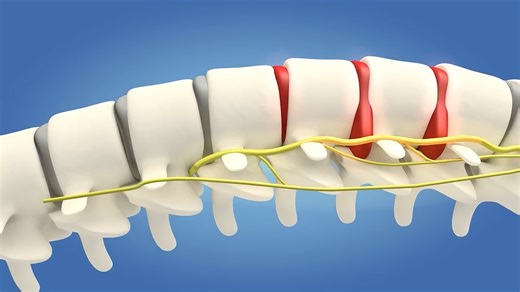 LWC_Spinal Decompression Simulated Animation
