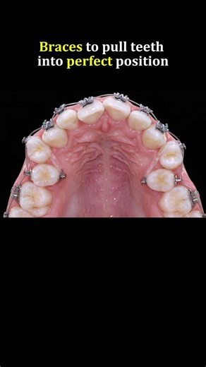 Amazing braces: Pull crooked teeth to perfect position #braces #foreigntraineddentist #orthodontics