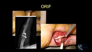 Hand Trauma: Management of Acute and Delayed Injuries