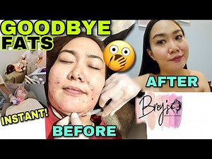 INSTANT BURN FAT with MESOTHERAPY + RF featuring BREY’S BEAUTY LOUNGE BACOLOD