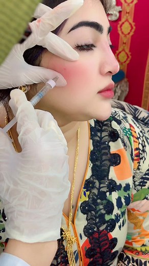 Cosmetic Treatment Overview: Cheek Filler Application