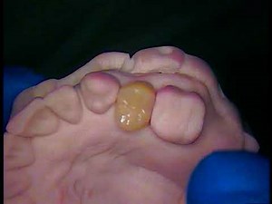 Crowns - How To Cement A Crown