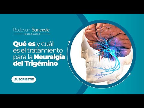 ¿Qué es y cuál es el tratamiento para la NEURALGIA DEL TRIGÉMINO? - Dr. Radovan Sancevic