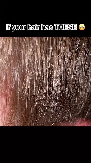 If Your Hair Has THESE White Dots… It’s damage😳💔 how to get healthy hair #hair #viral #haircare
