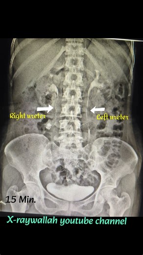 IVP PROCEDURE study normal