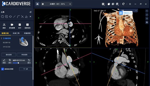 肺动脉瓣狭窄-尝试用Cardioverse看肺动脉瓣口
