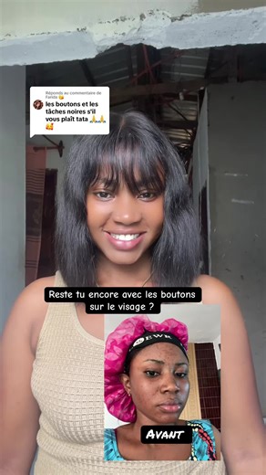 Astuce efficace contre les boutons sur le visage