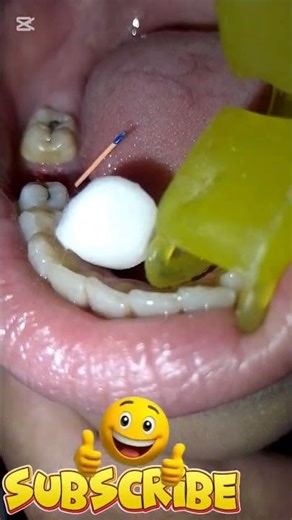 The method of obturating the root canal using sealer and gutta‑percha.