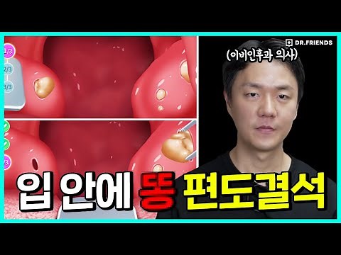 입에서 나는 똥냄새의 비밀 편도결석 제거 애니메이션 | 의사의 충격 리뷰! 절대로 따라하면 안되는 이유