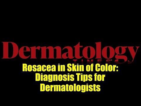 Rosacea in Skin of Color: Diagnosis Tips for Dermatologists