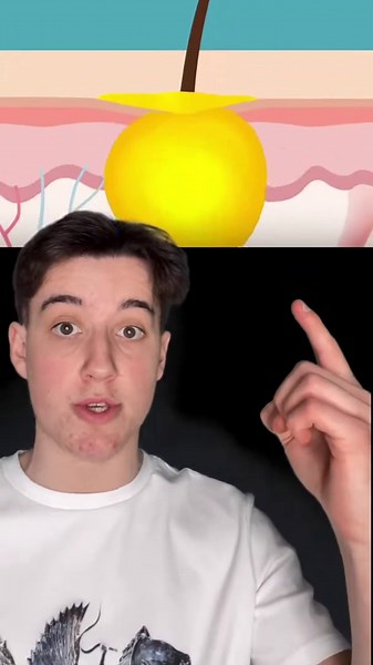 The real causes of pimples and why they appear on skin