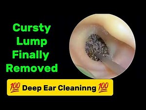 Ear Wax Removal | crusty lump finally removed