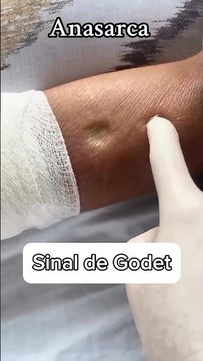 O sinal de Godet ou cacifo #viral #enfermagem #dicas