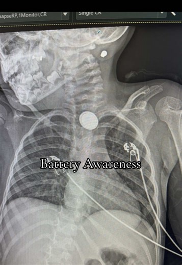 This video is about awareness, not blame. If sharing what happened to us helps protect even one child, it matters. Any negativity, judgment, or disrespect will be deleted. Please keep this space safe, informative, and kind. 🤍 Don’t mind the weird lips it’s the filter. #ButtonBatteryAwareness #MomWarning #ProtectOurChildren #Awareness #fyp