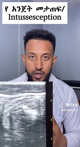 የ ትንሹ አንጀት መታጠፍ Ilio-ilial intussesception. #Radiology #abdominalultrasound#Ultrasound #diagnosis #ethiopian_tik_tok #fyp #creatorsearchinsights