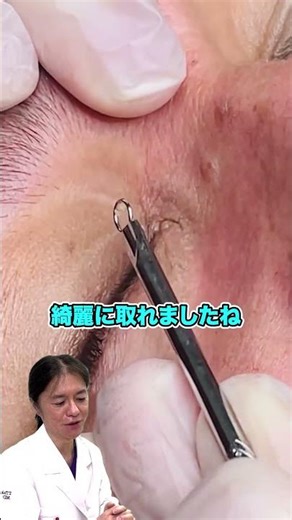 【目頭にある稗粒腫】医師でも苦戦する厄介な目頭の牌粒腫！綺麗に取り除きたい方はお近くの医療機関へ！