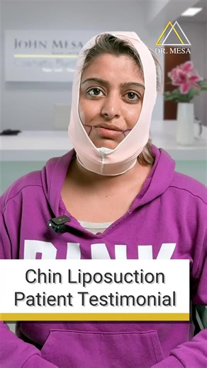 Chin Lipo By Dr. Mesa on Instagram: "Here's what my patient, Kaniz had to say after her Chin Liposuction procedure: ✨ "I just had chin lipo and I already see a difference! My face looks flatter, less chubby and the best part? I didn’t feel a thing!" My specialized technique, the Extended Chin Liposuction differs from your regular regular chin lipo: 💉 No pain, no discomfort, just a smooth procedure from start to finish. 👨‍⚕️ I highly specialize in chin lipo & buccal fat removal 🩺 Our team is s