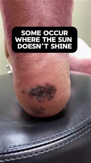 Most people were taught one image of melanoma: dark, irregular, changing, and obvious