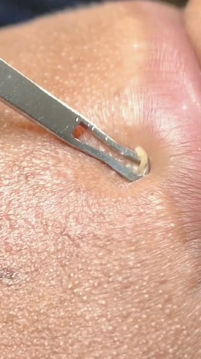 pimple remove on TikTok