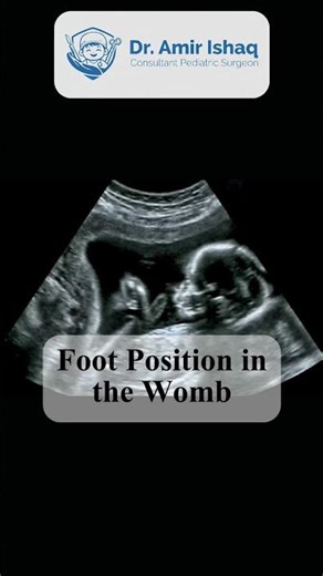 Clubfoot in Babies Explained | Causes of Clubfoot | Pediatric Surgeon Advice #pediatricsurgery