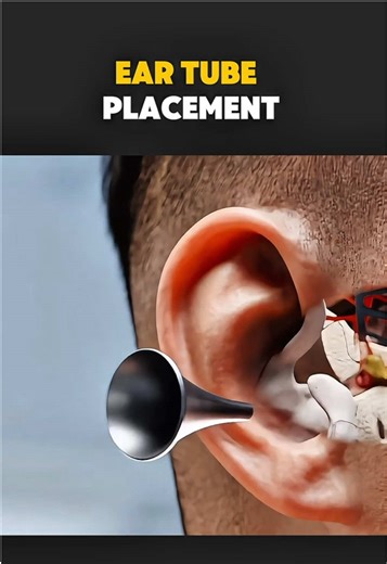 Ear tube placement (3d animation) #tubeplacement#eartubeplacement #3danimation