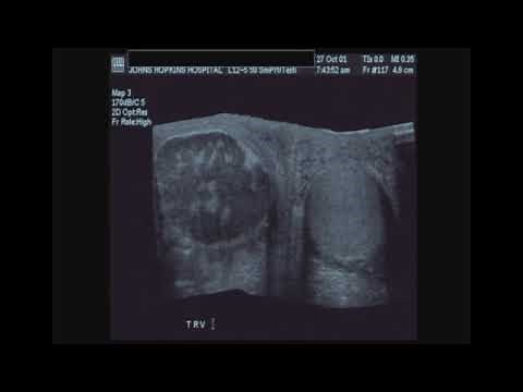Ultrasound in Evaluating Scrotal Pain