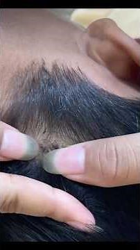 (Part 1) Removing Lice by Hand Satisfying Lice & Nits Removal #liceremoval #licetreatment #lice