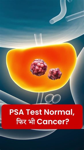 🧪 PSA normal पर भी Prostate Cancer ? | Prostate Cancer | Dr. Amit Bansal #shorts #shortsfeed