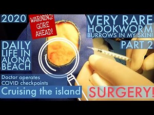 HOOKWORM SURGERY PARASITE REMOVAL - PART 2 - Daily Life at Alona Beach