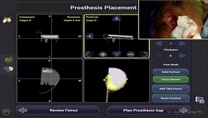 Robotic Partial Knee Arthroplasty - Navio Medial UKA