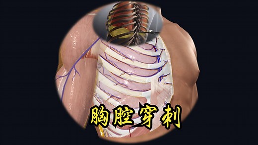 胸腔穿刺的过程及经过层次