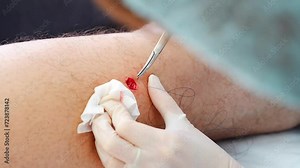 Dermatologist surgeon stitching up a wound after surgery, view of operation process