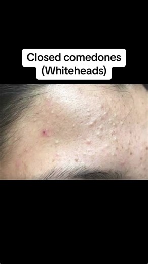 Effective Solutions for Whiteheads and Blackheads