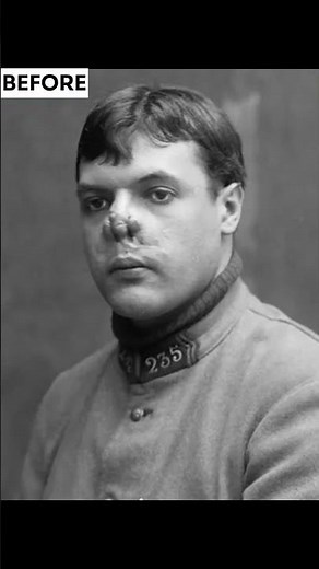 Disfigured World War I Soldiers Before and After #ww1 #beforeandafter #history