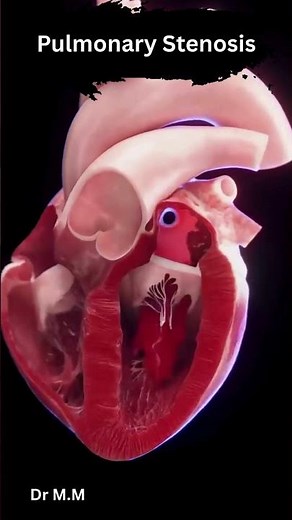 Pulmonary Stenosis Murmur: Heart Sound & Explanation 🩺